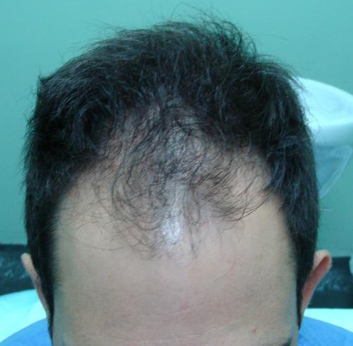 FUE transplant - 2,000 grafts